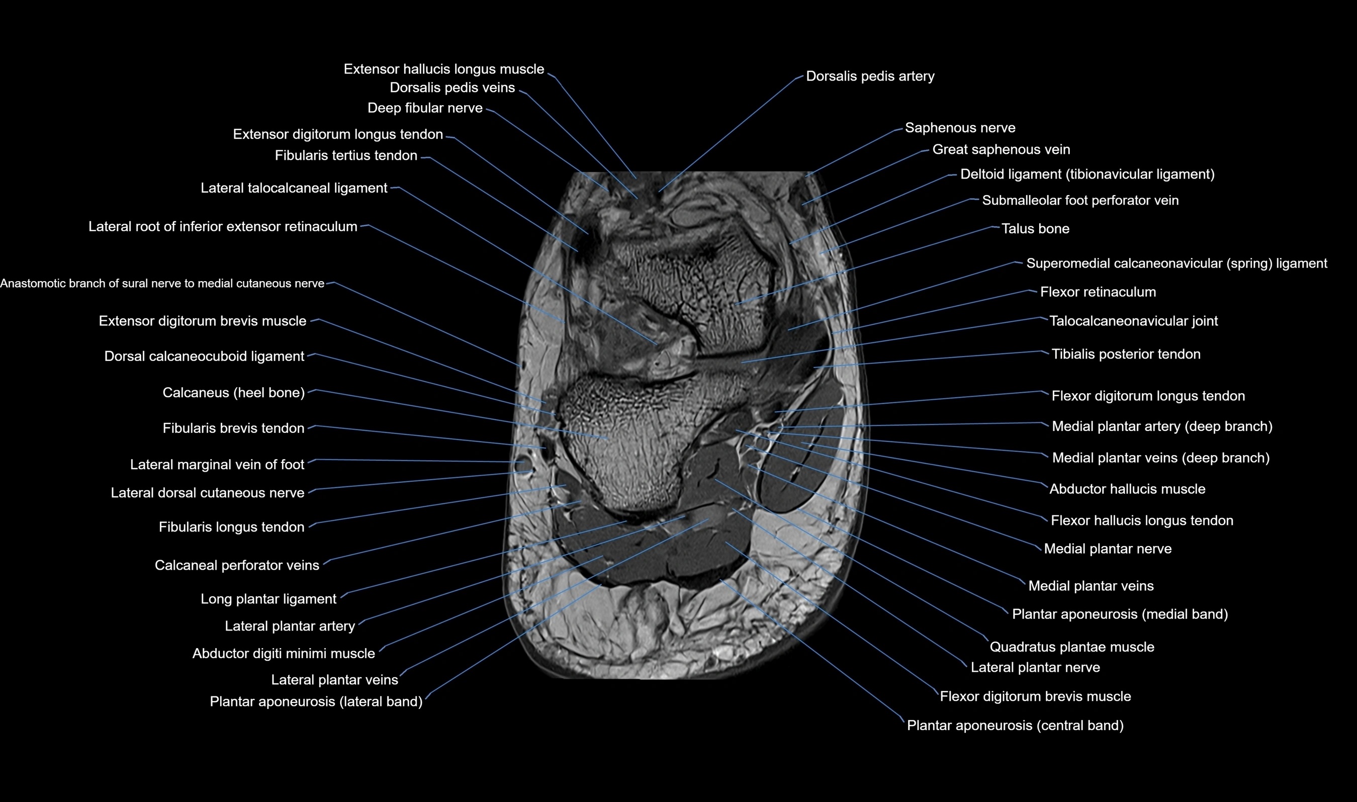 MRI mid foot axial cross sectional anatomy 3T  radiology  image-img-00001-00042.webp